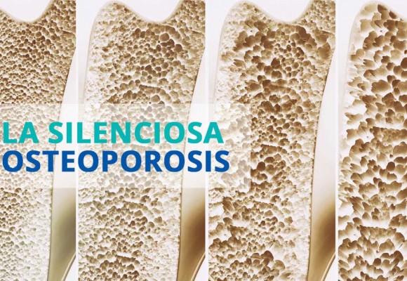 Osteoporosis ¿Quién puede padecerla? Todo el Mundo